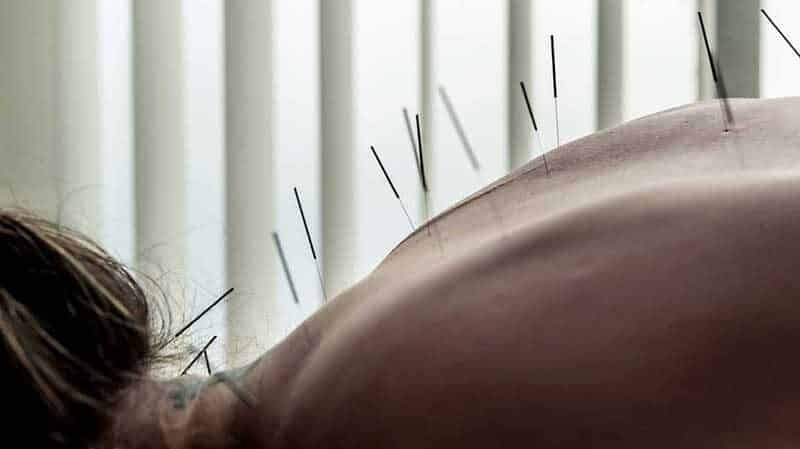 Acupuncture