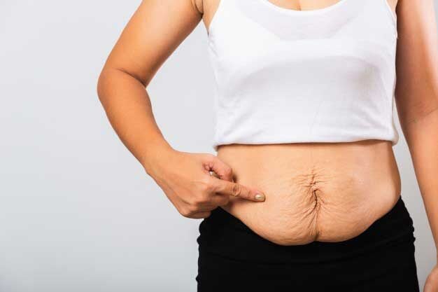 What Causes Stretch Marks Common Remedies Image