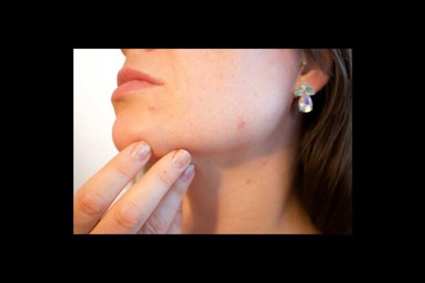 acne g9395c4e82