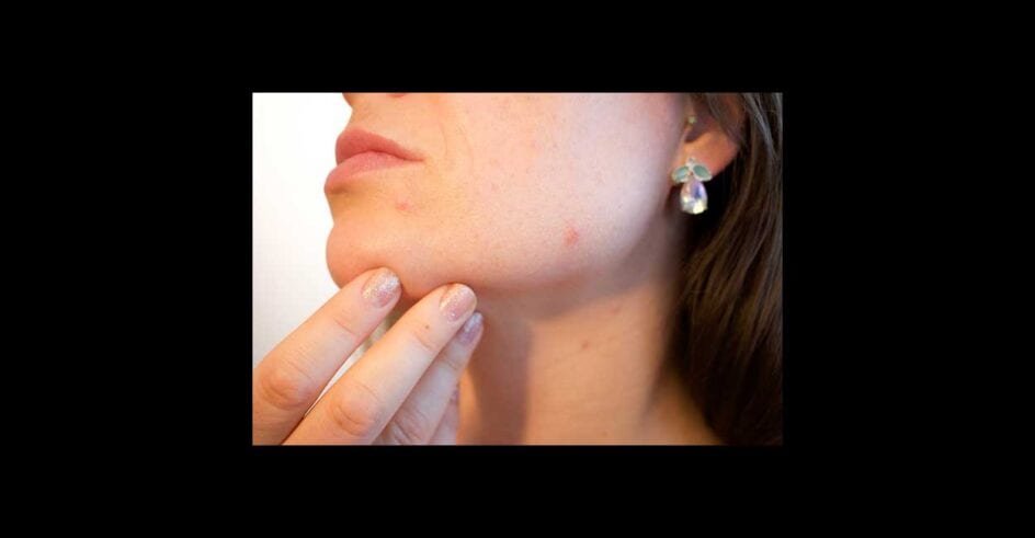 acne g9395c4e82