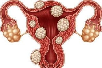 uterine fibroids