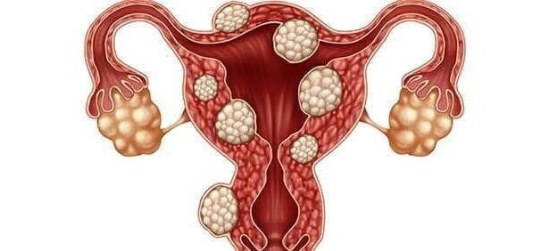 uterine fibroids