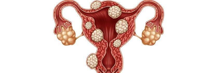 uterine fibroids