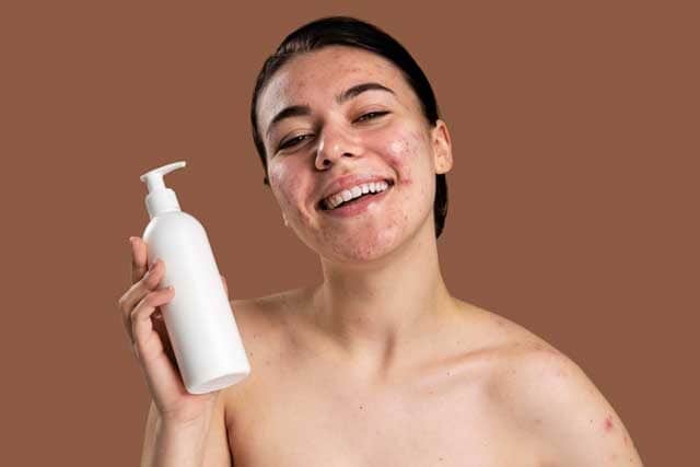 young woman being confident with her acne