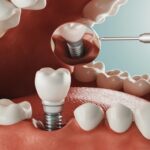 Dental implant