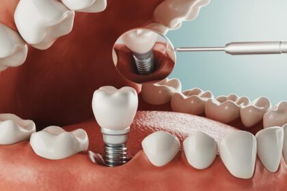 Dental implant