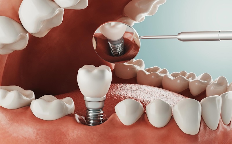 Dental implant