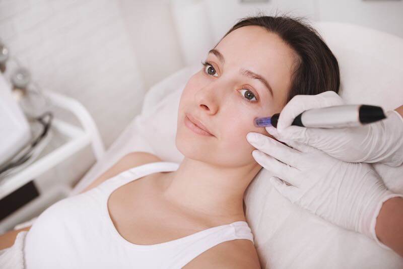 Skin Needling: How It Works and How To Maximise the Results